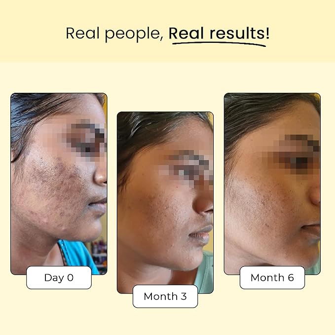 Skin Glow Supplement for Healthy and Glowing Skin |for Men and Women|Glutathione |Vitamin E |for Dull and Uneven Skin Tone Pigmentation and Dark Spots Removal - Pack of 1