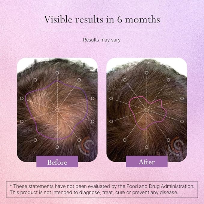 Omvi Formulas Hair Growth Supplement with Biotin 20000mcg Collagen Keratin Vitamin A C D3 &amp B12 Stronger Hair Skin and Nails Non-GMO Gluten Free 120Capsules