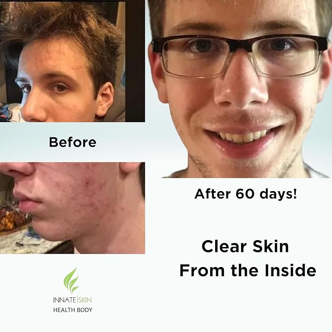 Clear Skin Acne Vitamin System | 20 Antioxidants Botanicals &amp Minerals | 60 Count Pack of 2