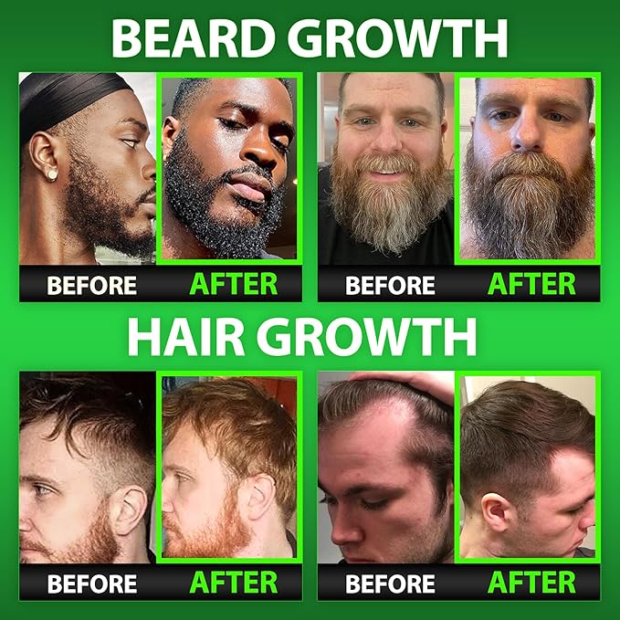 Beard Growth Kit w/ 6X Liquid BIOTIN Supplement with Collagen Peptides + 620000mcg 14-in-1 BIOTIN Gummies/Beard Growth Vitamins &amp Hair Growth Vitamins for Men - Formulated in America