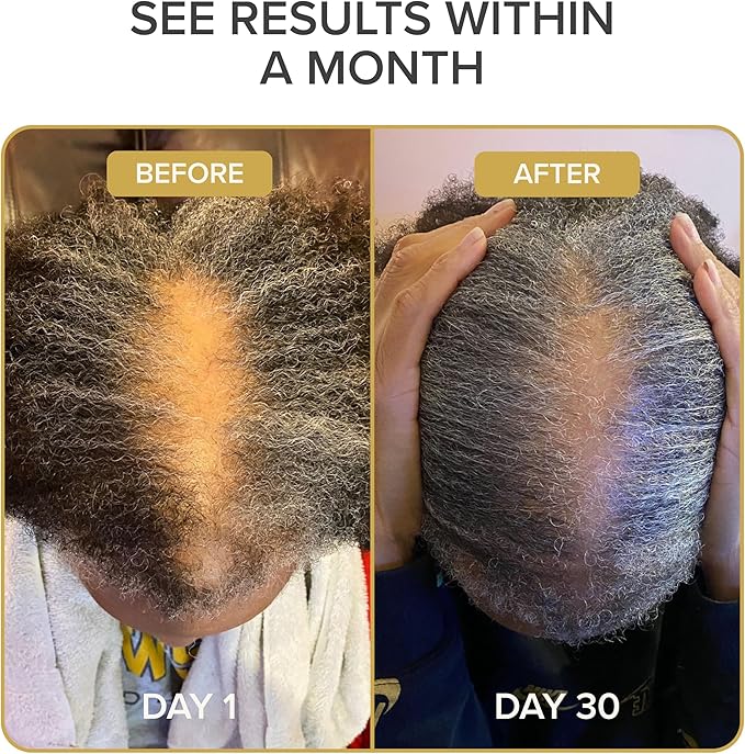 Shedavi Iconic Natural Hair Vitamins for Fast Hair Growth - Pure Hair Supplements Formulated with Vitamins to Promote Thicker Stronger Hair - Vegan Hair Care for Hair Loss - Non-GMO (60 Capsules)